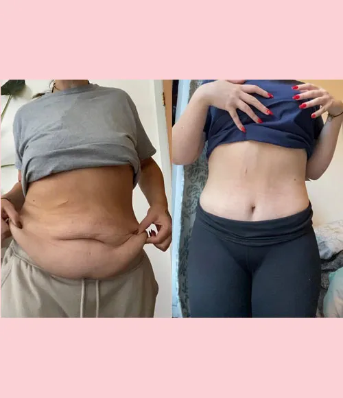 Tummy Tuck (Abdominoplasty) patient result 11