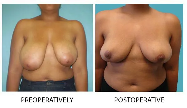 Breast Reduction (Mammoplasty) patient result 1
