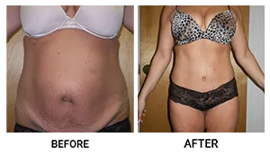 Tummy Tuck (Abdominoplasty) patient result 7