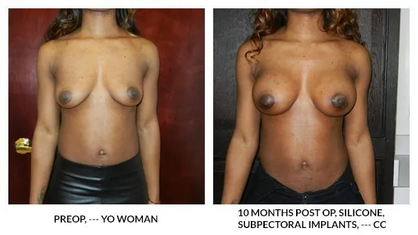 Breast Augmentation patient result 16