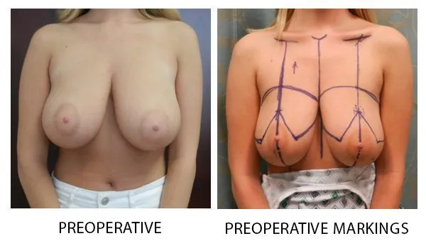 Breast Reduction (Mammoplasty) patient result 18