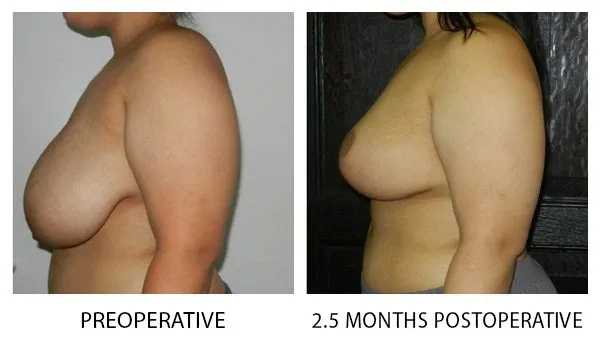 Breast Reduction (Mammoplasty) patient result 9