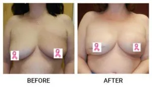 Breast Reconstruction patient result 3