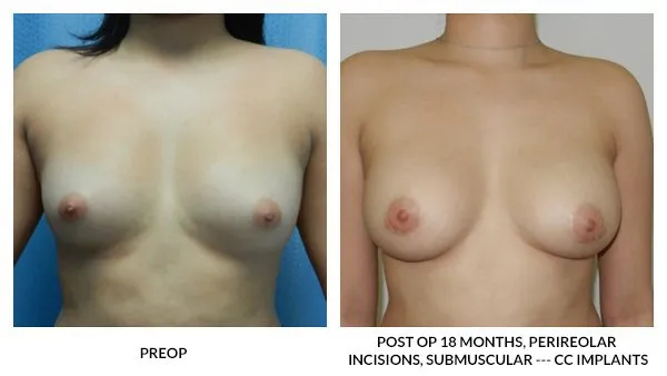 Breast Augmentation patient result 12