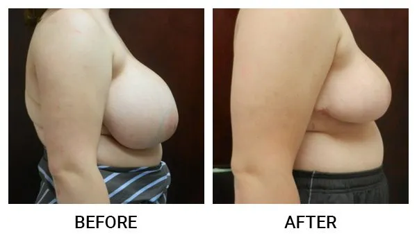 Breast Reduction (Mammoplasty) patient result 21