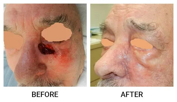 Mohs Reconstruction patient result 5