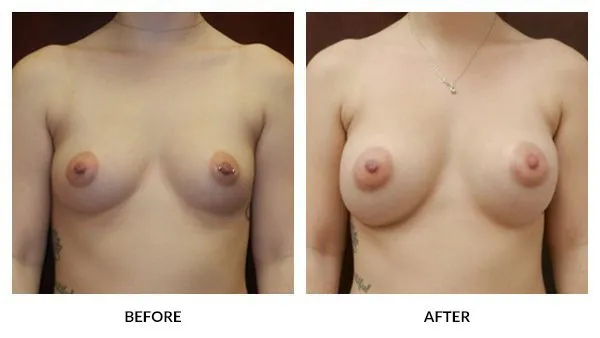 Breast Augmentation patient result 19