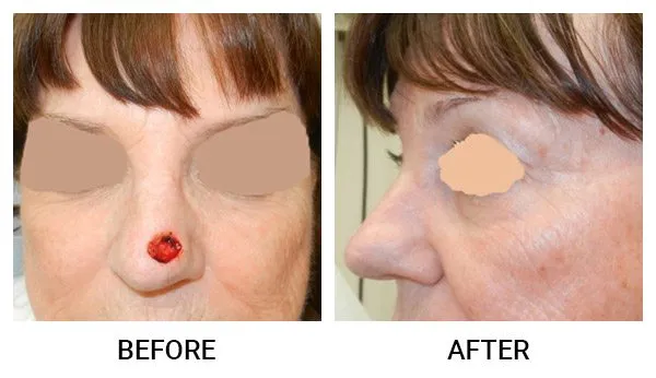 Mohs Reconstruction patient result 2