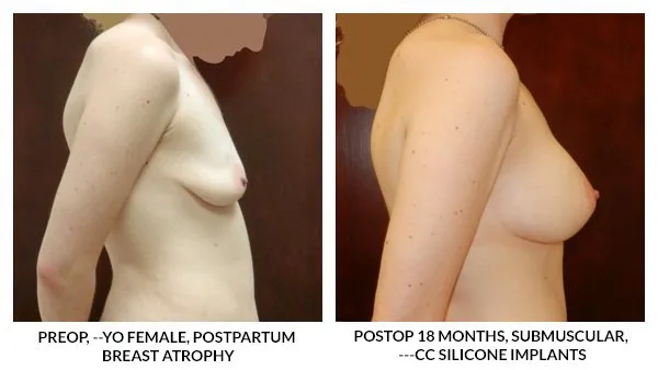 Breast Augmentation patient result 10