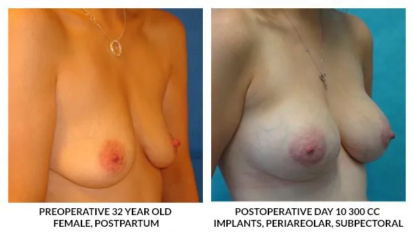 Breast Augmentation patient result 2