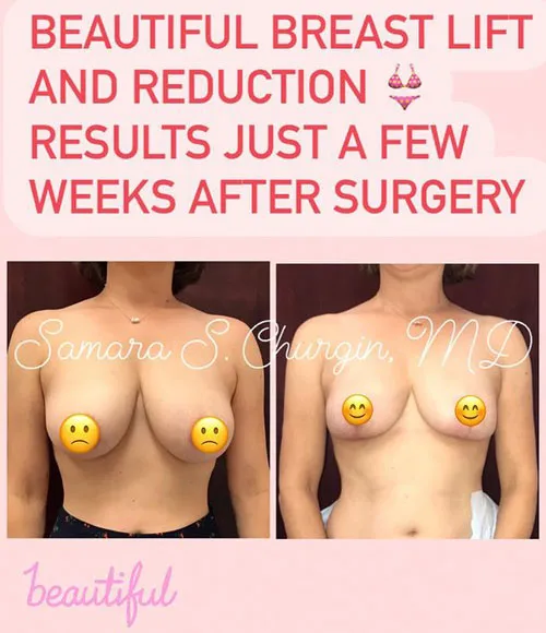 Breast Reduction (Mammoplasty) patient result 23