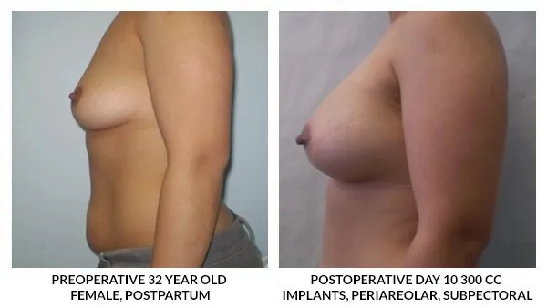 Breast Augmentation patient result 7