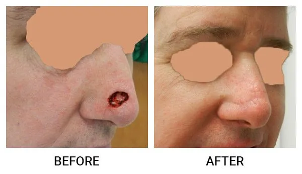 Mohs Reconstruction patient result 3