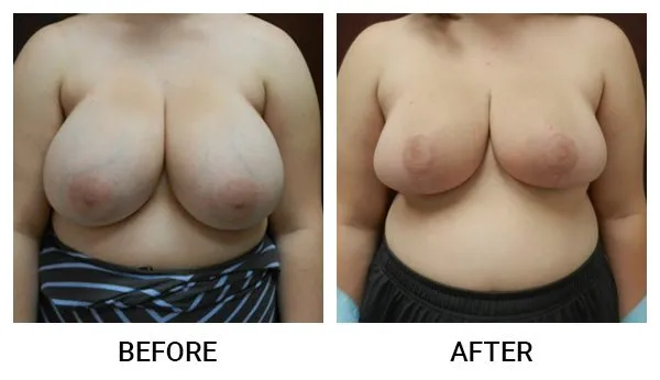 Breast Reduction (Mammoplasty) patient result 22