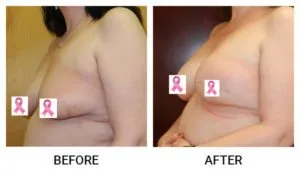 Breast Reconstruction patient result 4