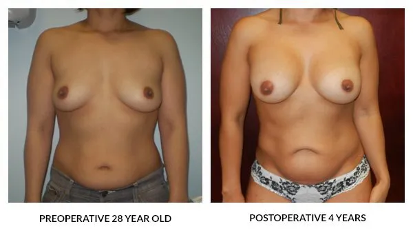 Breast Augmentation patient result 4