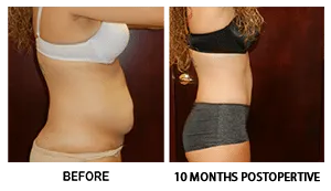 Tummy Tuck (Abdominoplasty) patient result 6
