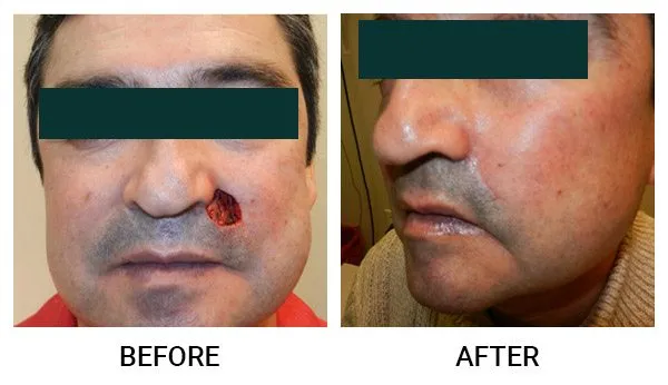 Mohs Reconstruction patient result 1