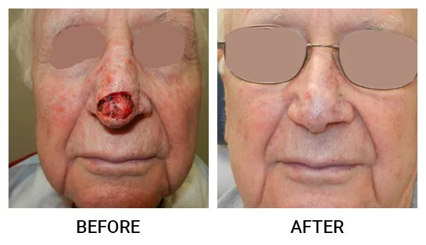 Mohs Reconstruction patient result 4