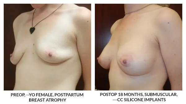 Breast Augmentation patient result 13
