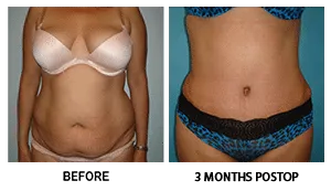 Tummy Tuck (Abdominoplasty) patient result 3