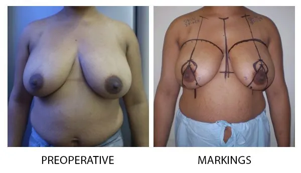Breast Reduction (Mammoplasty) patient result 19
