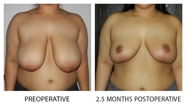 Breast Reduction (Mammoplasty) patient result 8