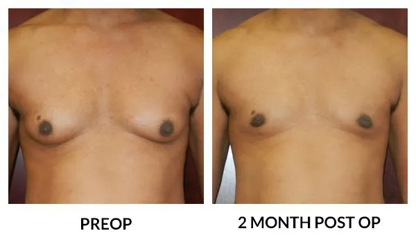 Gynecomastia patient result 5