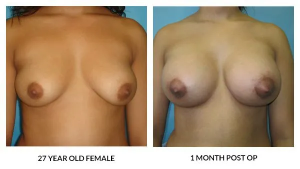 Breast Augmentation patient result 22