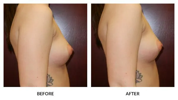 Breast Augmentation patient result 9
