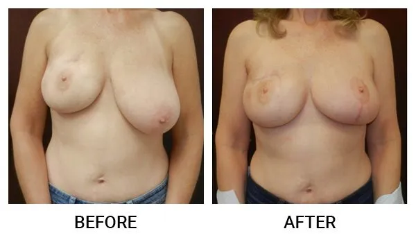Breast Reconstruction patient result 5