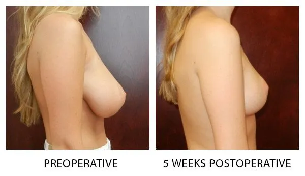 Breast Reduction (Mammoplasty) patient result 14
