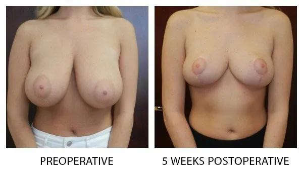 Breast Reduction (Mammoplasty) patient result 10